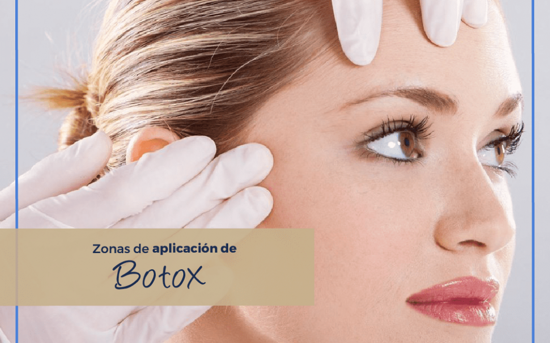 Zonas de Aplicación de Botox