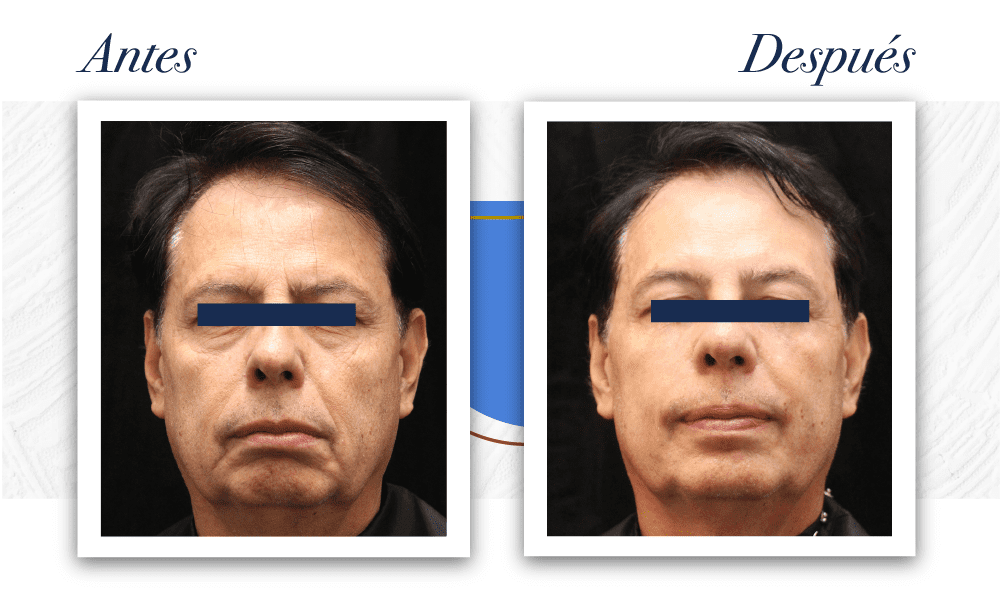 XIlis FacialYCorporal2