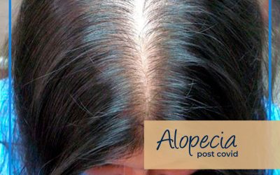 Alopecia Post-COVID
